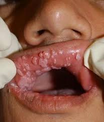 Virus del papiloma humano está afectando a hombres y mujeres pero también a niños recién nacidos