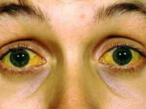Los ojos son la ventana del hígado cuando existe un problema hepático aquí se refleja