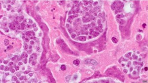 El paciente desarrolló cáncer de un parásito,¡increible!