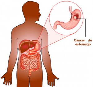 Cáncer de estómago produce dolores abdominales, vómitos repentinos, náuseas frecuentes y en ocasiones sangrado