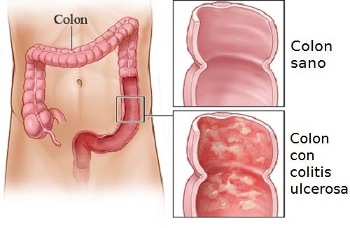 cancer de colon bioneuroemocion